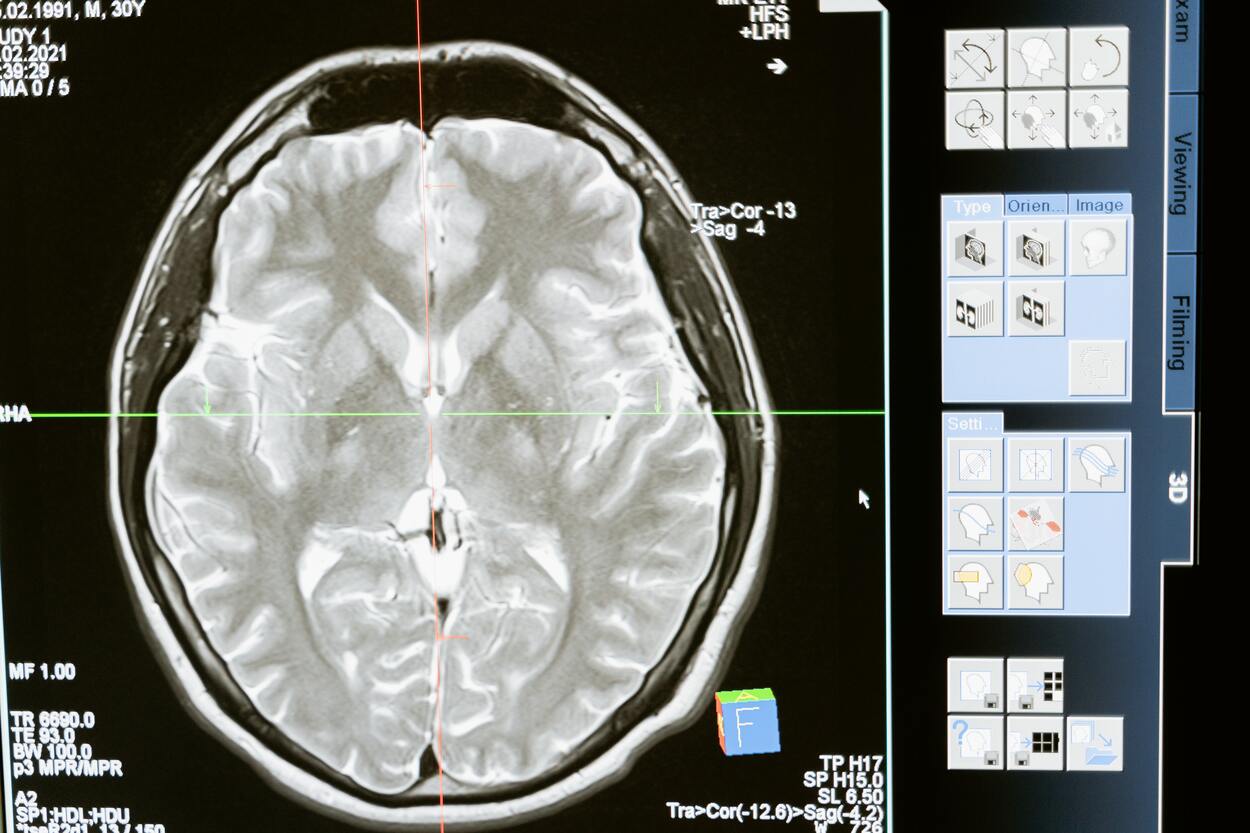 An image of brain through MRI.