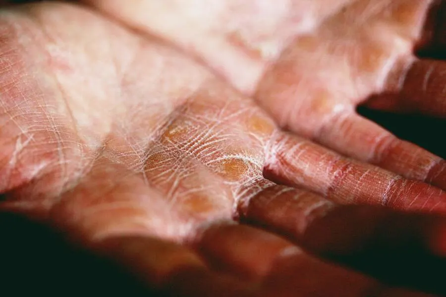A pair of hands with dried skin