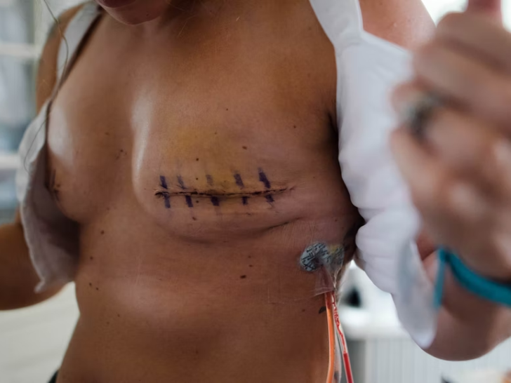 A women suffering from breast cancer treated and operated