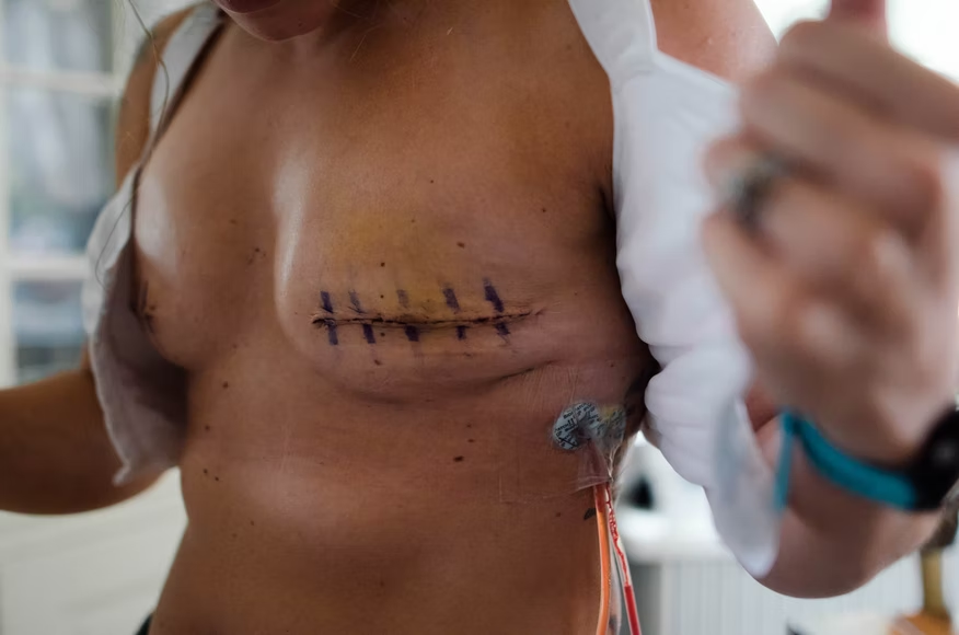 A women suffering from breast cancer treated and operated