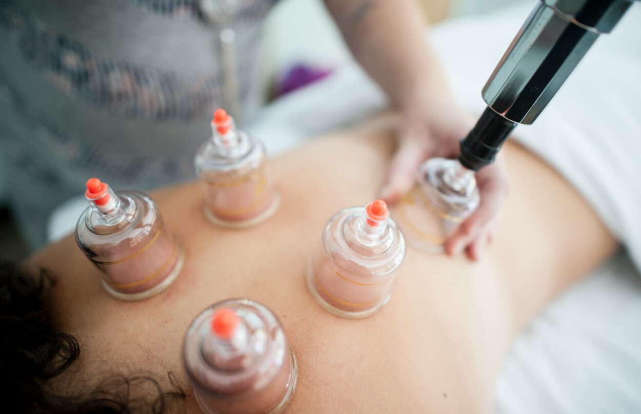 A person undergoing cupping therapy to increase blood circulation.